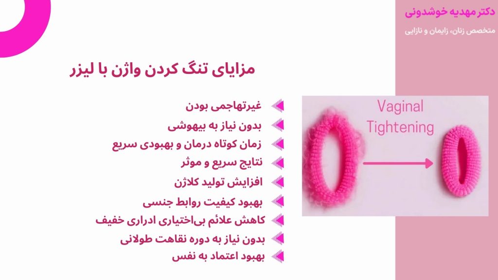 مزایای تنگ کردن واژن با لیزر
