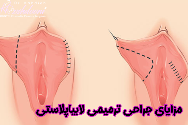 مزایای جراحی ترمیمی لابیاپلاستی