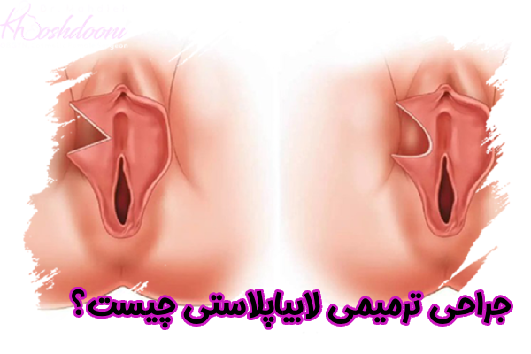 جراحی ترمیمی لابیاپلاستی چیست