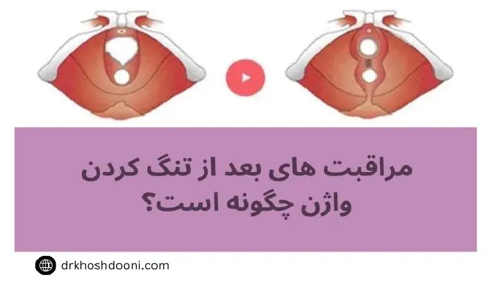 مراقبت های بعد از تنگ کردن واژن