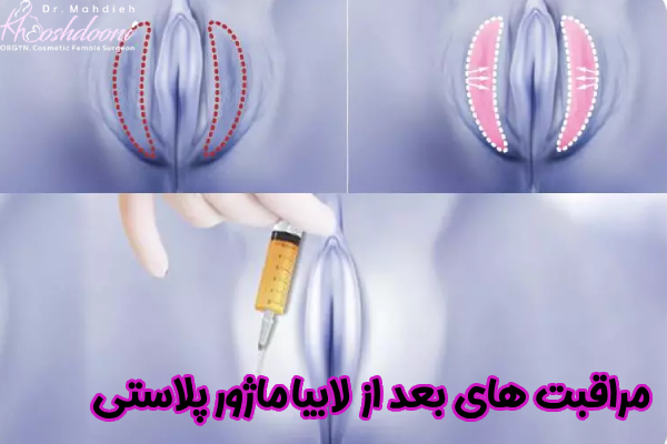 مراقبت های بعد از لابیاماژورپلاستی