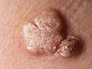 پیشگیری از زگیل تناسلی زنان