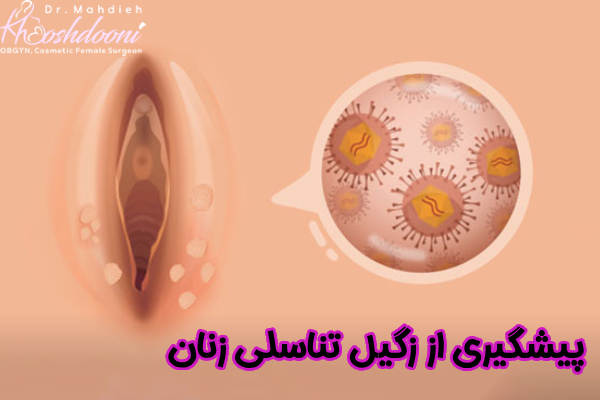 پیشگیری از زگیل تناسلی در زنان