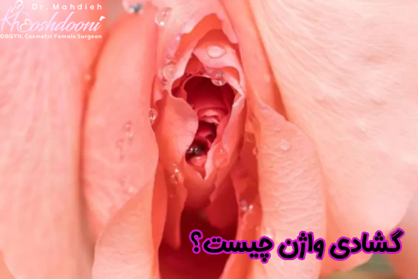 گشادی واژن چیست
