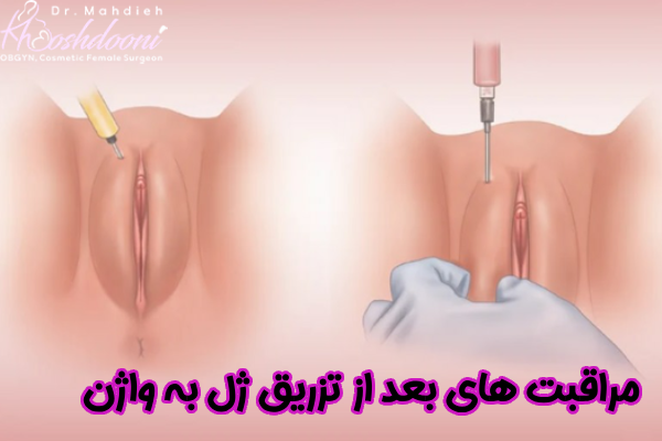 اقدامات بعد از تزریق ژل به واژن
