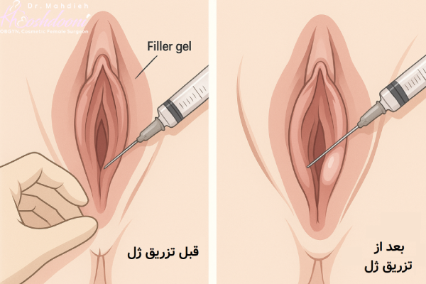 نوع بی حسی