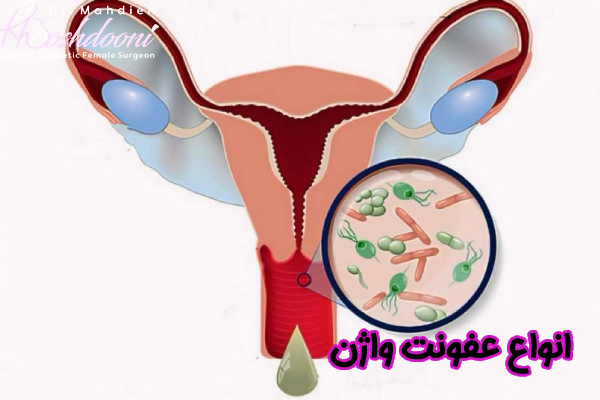 انواع عفونت واژن