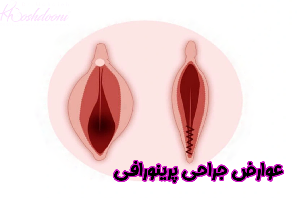 عوارض جراحی پرینورافی