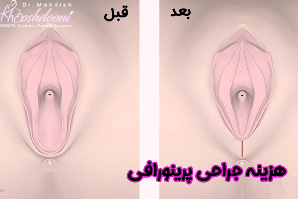 هزینه جراحی پرینورافی