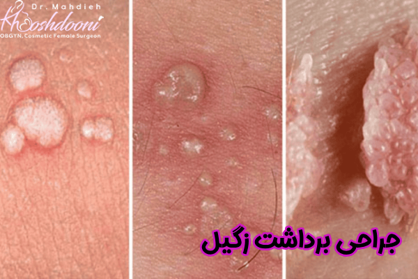 جراحی برداشت زگیل