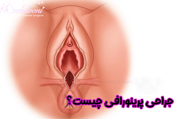جراحی پرینورافی چیست