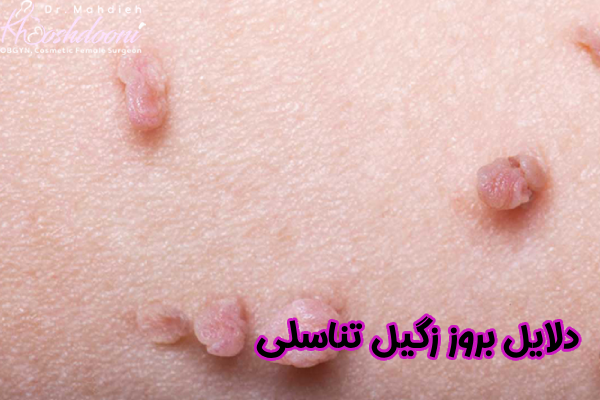 دلایل بروز زگیل تناسلی