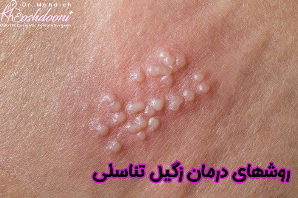 روشهای درمان زگیل تناسلی
