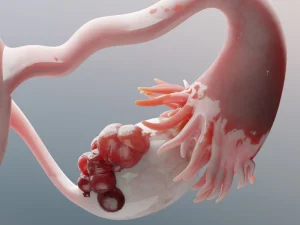 کیست تخمدان