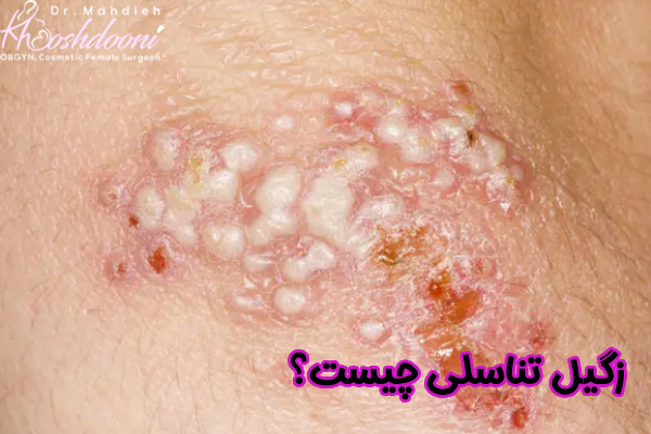 زگیل تناسلی چیست