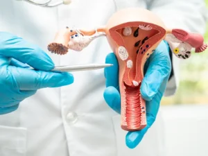 عوارض فیبروم رحم