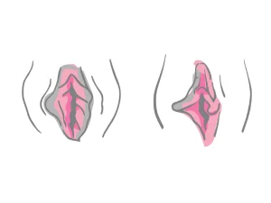 نامتقارن بودن لبه های واژن