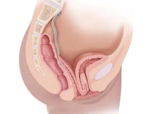 عوارض جراحی افتادگی مثانه