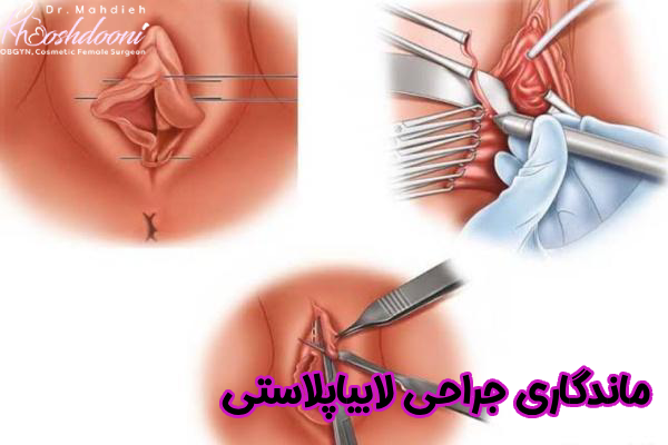 ماندگاری جراحی لابیاپلاستی