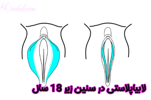 لابیاپلاستی زیر 18 سال
