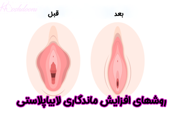 روش های افزایش ماندگاری لابیاپلاستی