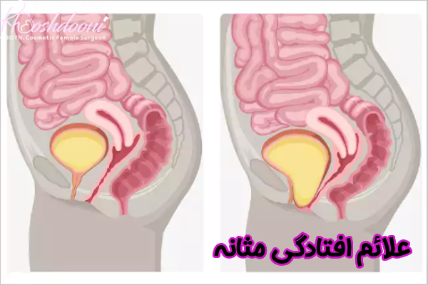 علائم افتادگی مثانه