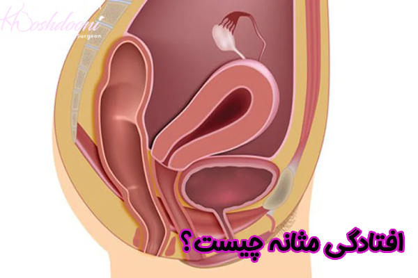 افتادگی مثانه چیست