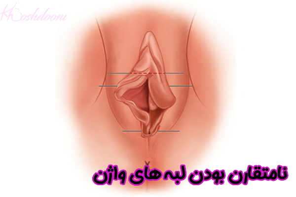 نامتقارن بودن لبه های واژن چیست